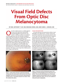 Visual Field Defects from Optic Disc Melanocytoma