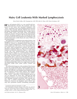 Hairy Cell Leukemia with Marked Lymphocytosis