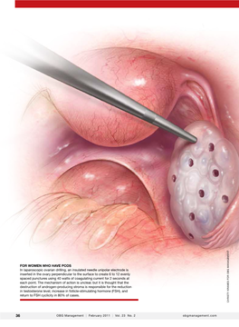 FOR WOMEN WHO HAVE PCOS in Laparoscopic Ovarian Drilling, an Insulated Needle Unipolar Electrode Is Ma