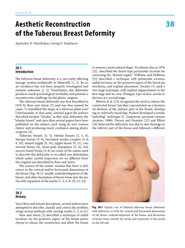 38 Aesthetic Reconstruction of the Tuberous Breast Deformity
