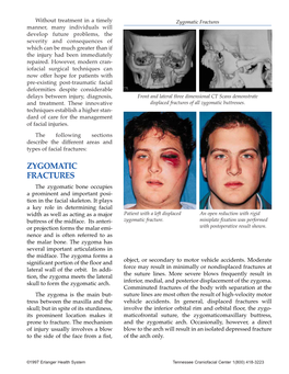 Zygomatic Fractures