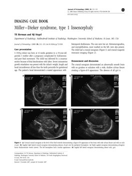 Miller–Dieker Syndrome, Type 1 Lissencephaly