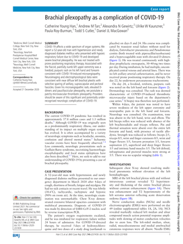 Brachial Plexopathy As a Complication of COVID-19