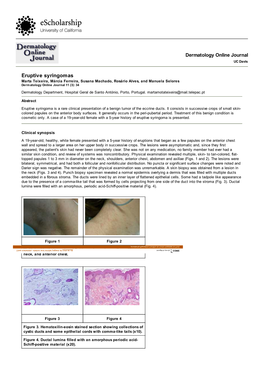 Eruptive Syringomas Marta Teixeira, Márcia Ferreira, Susana Machado, Rosário Alves, and Manuela Selores Dermatology Online Journal 11 (3): 34