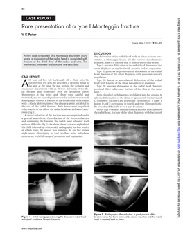 Rare Presentation of a Type I Monteggia Fracture V K Peter