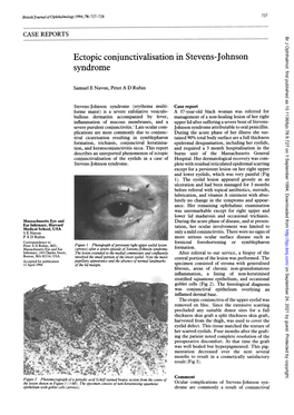 Ectopic Conjunctivalisation in Stevens-Johnson Syndrome