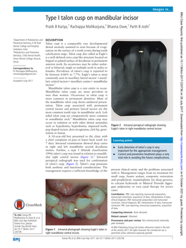 Type I Talon Cusp on Mandibular Incisor Pratik B Kariya,1 Rachappa Mallikarjuna,2 Bhavna Dave,1 Parth B Joshi1