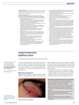 Aphthous Ulcers