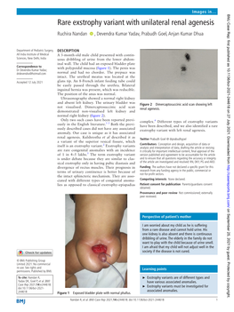 Rare Exstrophy Variant with Unilateral Renal Agenesis Ruchira Nandan ‍ ‍ , Devendra Kumar Yadav, Prabudh Goel, Anjan Kumar Dhua