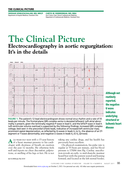 Electrocardiography in Aortic Regurgitation: It's in the Details