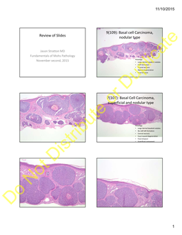 Basal Cell Carcinoma, Superficial and Nodular Typeor