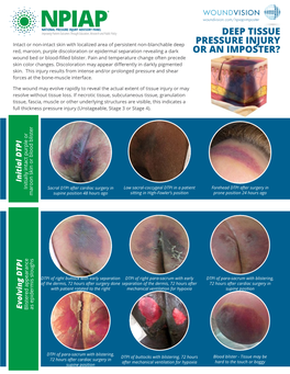 Deep Tissue Pressure Injury Or an Imposter?