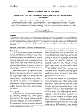 Veneers in Esthetic Zone – a Case Series