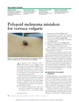 Polypoid Melanoma Mistaken for Verruca Vulgaris