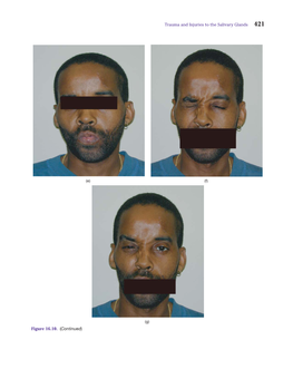 Trauma and Injuries to the Salivary Glands Figure 16.10. (Continued)