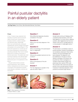 Painful Pustular Dactylitis in an Elderly Patient