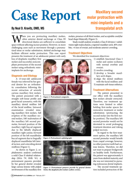 Case Report Maxillary Second Molar Protraction with Mini-Implants and A