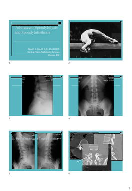 Adolescent Spondylolysis and Spondylolisthesis