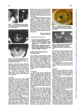 Asteroides to Trimethoprim-Sulphamethoxazole.' Cular Invasion Or Lipid Infiltration