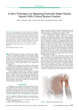 A New Technique for Repairing Pectoralis Major Muscle Injuries with Cortical Button Fixation