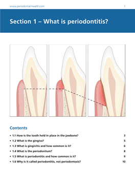 Section 1 – What Is Periodontitis?