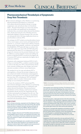 Pharmacomechanical Thrombolysis of Symptomatic Deep Vein Thrombosis