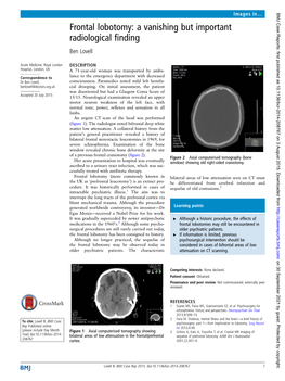 Frontal Lobotomy: a Vanishing but Important Radiological ﬁnding Ben Lovell