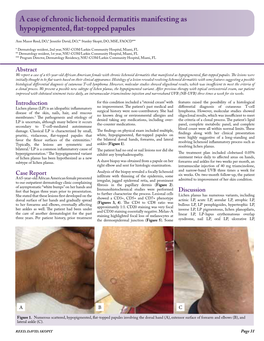 A Case of Chronic Lichenoid Dermatitis Manifesting As Hypopigmented, Flat-Topped Papules