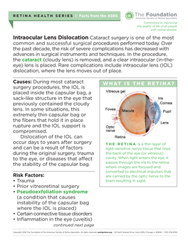 Intraocular Lens Dislocation Cataract Surgery Is One of the Most Common and Successful Surgical Pro­Cedures Performed Today