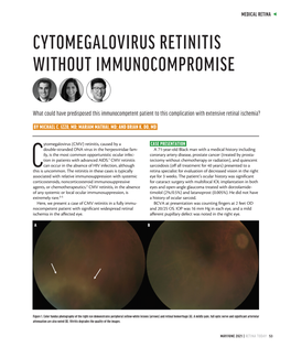 Cytomegalovirus Retinitis Without Immunocompromise