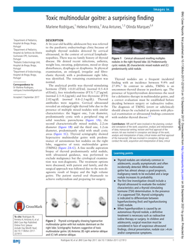 Toxic Multinodular Goitre: a Surprising Finding Marlene Rodrigues,1 Helena Ferreira,2 Ana Antunes,1,3 Olinda Marques3,4