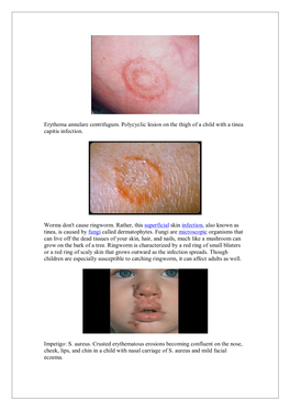 Erythema Annulare Centrifugum. Polycyclic Lesion on the Thigh of a Child with a Tinea Capitis Infection