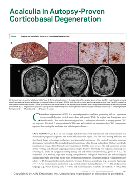 Acalculia in Autopsy-Proven Corticobasal Degeneration