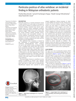 Ponticulus Posticus of Atlas Vertebrae: an Incidental Finding in Malaysian