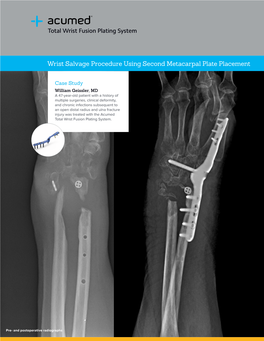 Wrist Salvage Procedure Using Second Metacarpal Plate Placement