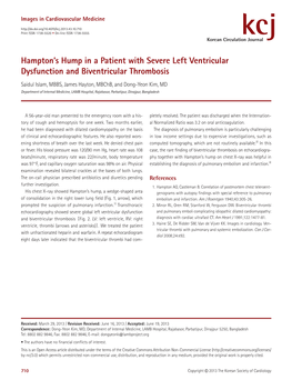 Hampton's Hump in a Patient with Severe Left Ventricular Dysfunction and Biventricular Thrombosis