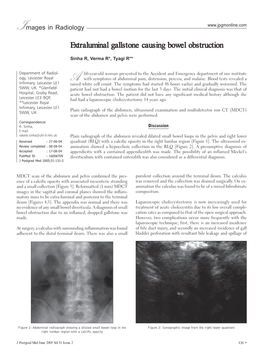 Extraluminal Gallstone Causing Bowel Obstruction