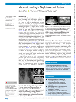 Metastatic Seeding in Staphylococcus Infection Navneet Arora ‍ ‍ ,1 Atul Saroch,1 Nikita Verma,2 Pankaj Gupta2