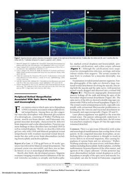 Peripheral Retinal Nonperfusion Associated with Optic Nerve