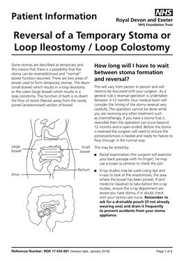 Patient Information Reversal of a Temporary Stoma Or Loop Ileostomy / Loop Colostomy