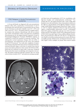 CNS Relapse in Acute Promyeloctyic Leukemia