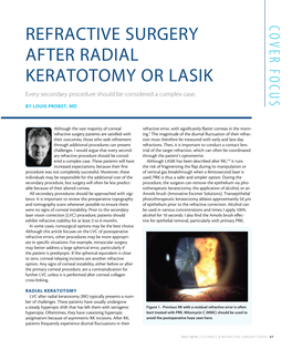 REFRACTIVE SURGERY AFTER RADIAL KERATOTOMY OR LASIK Every Secondary Procedure Should Be Considered a Complex Case