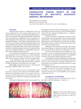 Connective Tissue Graft in the Treatment of Multiple Adjacent Gingival Recessions
