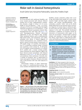 Malar Rash in Classical Homocystinuria Arushi Gahlot Saini, Hansashree Padmanabha, Savita Attri, Pratibha Singhi