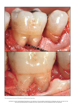 The International Journal of Periodontics & Restorative Dentistry