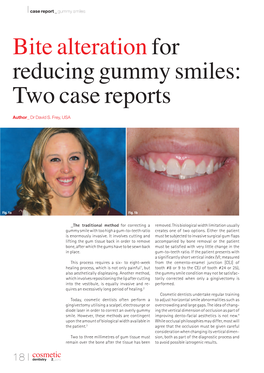 Bite Alteration for Reducing Gummy Smiles: Two Case Reports