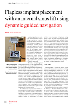 Flapless Implant Placement with an Internal Sinus Lift Using Dynamic Guided Navigation