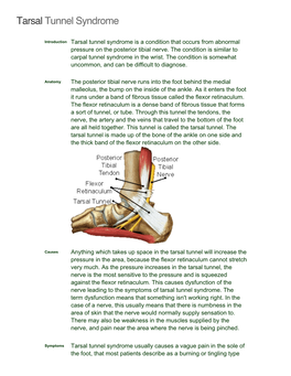 Tarsal Tunnel Syndrome