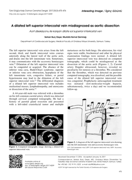 A Dilated Left Superior Intercostal Vein Misdiagnosed As Aortic Dissection