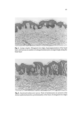 Fig. 1. Lentigo Simplex. Elongated Rete Ridges, Hyperpigmentation of The